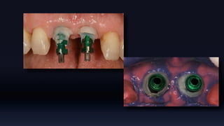 Tissue Management of Peri-implant Tissue