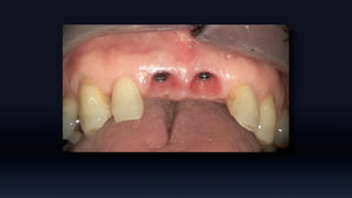 Tissue Management of Peri-implant Tissue