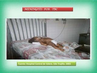 MENINGITIS POR TBC




Fuente: Hospital Central de Valera. Edo Trujillo. 2003
 