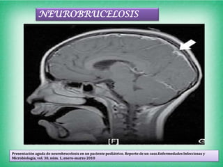 NEUROBRUCELOSIS




Presentación aguda de neurobrucelosis en un paciente pediátrico. Reporte de un caso.Enfermedades Infecciosas y
Microbiología, vol. 30, núm. 1, enero-marzo 2010
 
