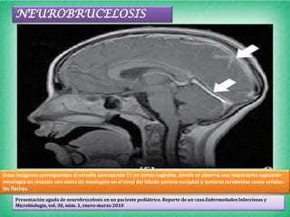 NEUROBRUCELOSIS




Estas imágenes corresponden al estudio contrastado T1 en cortes sagitales, donde se observa una importante captación
meníngea en relación con datos de meningitis en el nivel del lóbulo parieto-occipital y tentorio cerebeloso como señalan
las flechas.
     Presentación aguda de neurobrucelosis en un paciente pediátrico. Reporte de un caso.Enfermedades Infecciosas y
     Microbiología, vol. 30, núm. 1, enero-marzo 2010
 