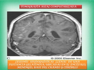TOMOGRAFÍA AXIAL COMPUTARIZADA




    LESIONES SEUDOQUÍSTICAS LLENAS DE UNA
SUSTANCIA GELATINOSA, UBICADAS EN EL ENCÉFALO,
     MENINGES, BASE DEL CRÁNEO Y CERÉBELO
 