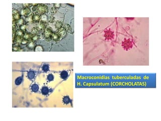 Macroconidias tuberculadas de
H. Capsulatum (CORCHOLATAS)
 