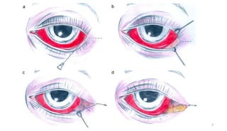 Cataract Incision Closure Complication of small incision cataract surgery | PPTX