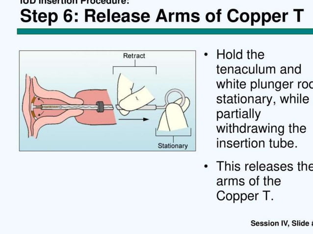 Copper T insertion | PPT