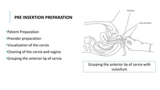 PRE INSERTION PREPARATION
•Patient Preparation
•Provider preparation
•Visualization of the cervix
•Cleaning of the cervix and vagina
•Grasping the anterior lip of cervix
Grasping the anterior lip of cervix with
vulsellum
 