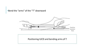 •Bend the “arms” of the “T” downward
Positioning IUCD and bending arms of T
 