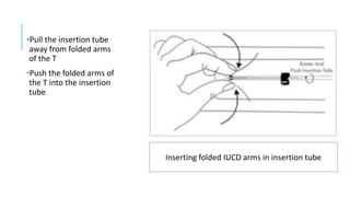 •Pull the insertion tube
away from folded arms
of the T
•Push the folded arms of
the T into the insertion
tube
Inserting folded IUCD arms in insertion tube
 