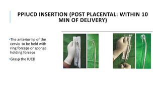 PPIUCD INSERTION (POST PLACENTAL: WITHIN 10
MIN OF DELIVERY)
•The anterior lip of the
cervix to be held with
ring forceps or sponge
holding forceps
•Grasp the IUCD
 
