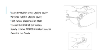 •Insert PPIUCD in lower uterine cavity
•Advance IUCD in uterine cavity
•High fundal placement of IUCD
•release the IUCD at the fundus.
•Slowly remove PPIUCD insertion forceps
•Examine the Cervix
 