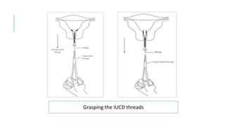 Grasping the IUCD threads
 