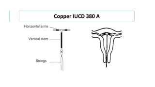 Copper IUCD 380 A
 