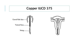 Copper IUCD 375
 