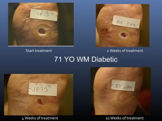 Start treatment 2 Weeks of treatment
4 Weeks of treatment 10 Weeks of treatment
71 YO WM Diabetic
 
