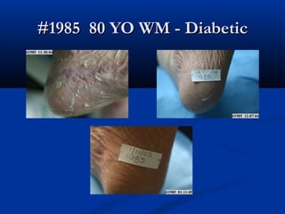#1985 80 YO WM - Diabetic#1985 80 YO WM - Diabetic
 
