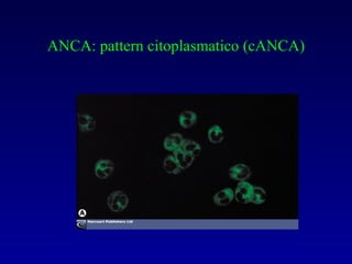 ANCA: pattern citoplasmatico (cANCA) 