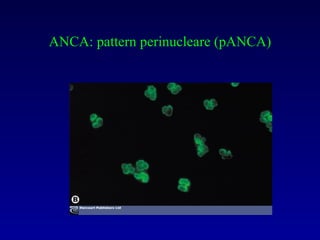 ANCA: pattern perinucleare (pANCA) 