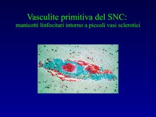 Vasculite primitiva del SNC:  manicotti linfocitari intorno a piccoli vasi sclerotici 