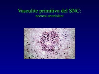 Vasculite primitiva del SNC: necrosi arteriolare 