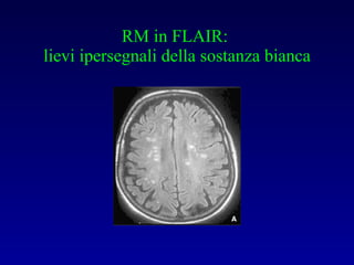 RM in FLAIR:  lievi ipersegnali della sostanza bianca 