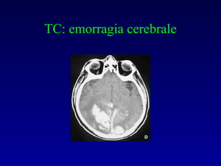 TC: emorragia cerebrale 