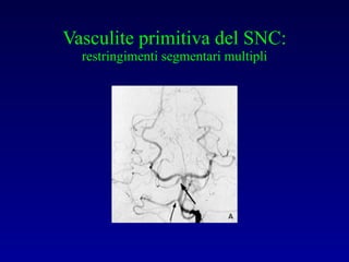Vasculite primitiva del SNC: restringimenti segmentari multipli 