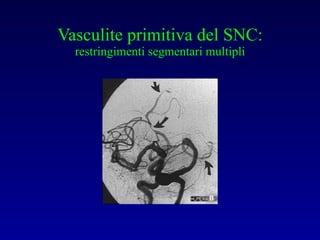Vasculite primitiva del SNC: restringimenti segmentari multipli 