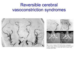 Reversible cerebral vasoconstriction syndromes 
