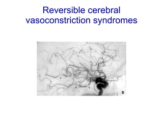 Reversible cerebral vasoconstriction syndromes 