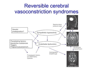 Reversible cerebral vasoconstriction syndromes 