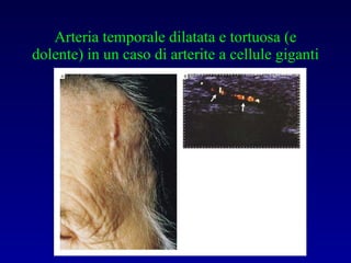 Arteria temporale dilatata e tortuosa (e dolente) in un caso di arterite a cellule giganti 