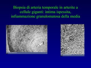Biopsia di arteria temporale in arterite a cellule giganti: intima ispessita, infiammazione granulomatosa della media 