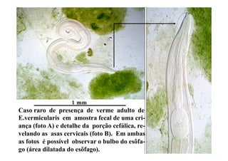 Caso raro de presença de verme adulto de
E.vermicularis em amostra fecal de uma cri-
ança (foto A) e detalhe da porção cefálica, re-
velando as asas cervicais (foto B). Em ambas
as fotos é possível observar o bulbo do esôfa-
go (área dilatada do esôfago).
 