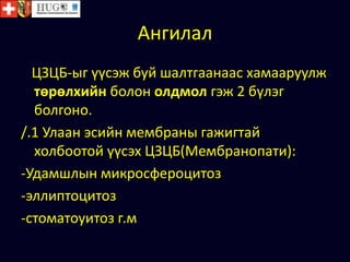 Ангилал
ЦЗЦБ-ыг үүсэж буй шалтгаанаас хамааруулж
төрөлхийн болон олдмол гэж 2 бүлэг
болгоно.
/.1 Улаан эсийн мембраны гажигтай
холбоотой үүсэх ЦЗЦБ(Мембранопати):
-Удамшлын микросфероцитоз
-эллиптоцитоз
-стоматоуитоз г.м
 