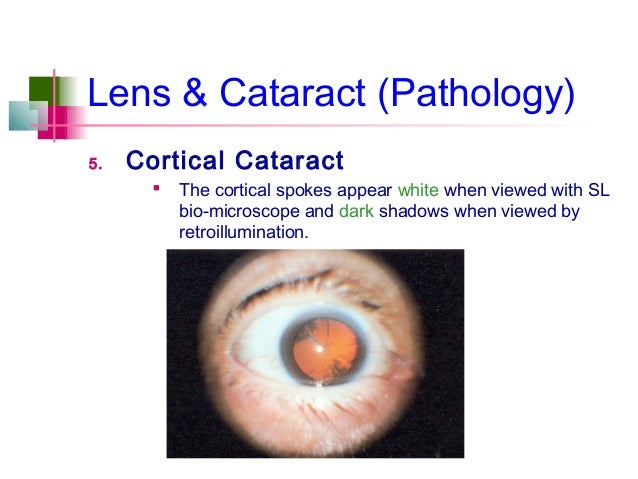 cortical cataract