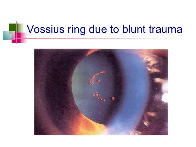 Age related Cataract