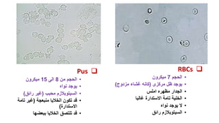 
Pus
•
‫الحجم‬
‫من‬
8
‫الى‬
15
‫ميكرون‬
•
‫نواه‬ ‫يوجد‬
•
‫محبب‬ ‫السيتوبالزم‬
(
‫رائق‬ ‫غير‬
)
•
‫منبعجة‬ ‫الخاليا‬ ‫تكون‬ ‫قد‬
(
‫تامة‬ ‫غير‬
‫االستدارة‬
)
•
‫ببعضها‬ ‫الخاليا‬ ‫تلتصق‬ ‫قد‬

RBCs
•
‫الحجم‬
7
‫ميكرون‬
•
‫يوجد‬
‫مركزى‬ ‫ظل‬
(
‫مزدوج‬ ‫غشاء‬ ‫كانه‬
)
•
‫مظهره‬ ‫الجدار‬
‫املس‬
•
‫غالبا‬ ‫االستدارة‬ ‫تامة‬ ‫الخلية‬
•
‫ال‬
‫يوجد‬
‫نواه‬
•
‫رائق‬ ‫السيتوبالزم‬
 