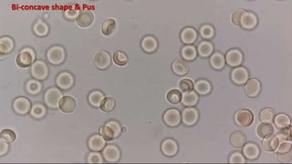 Bi-concave shape & Pus
 
