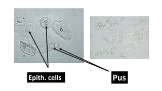 Epith. cells Pus
 