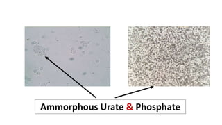 Ammorphous Urate & Phosphate
 