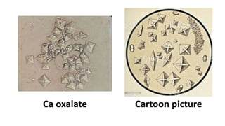 Ca oxalate Cartoon picture
 