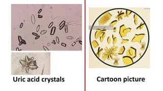 Uric acid crystals Cartoon picture
 