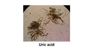 Uric acid
 