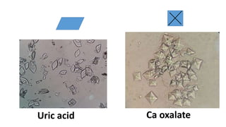 Uric acid Ca oxalate
 