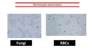 Microscopic examination
Fungi RBCs
 