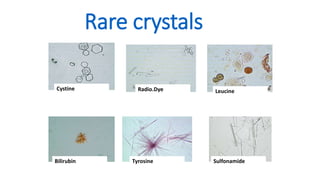 Rare crystals
Cystine
Tyrosine
Radio.Dye Leucine
Sulfonamide
Bilirubin
 