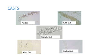 CASTS
Pus Cast R.B.C Cast
Waxy Cast
Granular Cast
Hyaline Cast
 