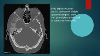 Comprehensive Overview of Fibrous Dysplasia: Diagnosis and Clinical ...
