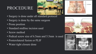PROCEDURE
• Surgery is done under all standard protocol
• Surgery is done by the same surgeon
• Prone position
• Standard midline incision used
• Screw method
• Pedical screw size of 6.5mm and 5.5mm is used
• Posterolateral fusion or PLIF
• Water tight closure done
 
