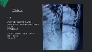 48/F
C/O PAIN LOWER BACK
RADIATING PAIN BOTH LOWER
LIMB
POWER 5/5
L3- L4 GRADE - I LISTHESIS
ODI - 30/50
VAS – 7
CASE 1
 